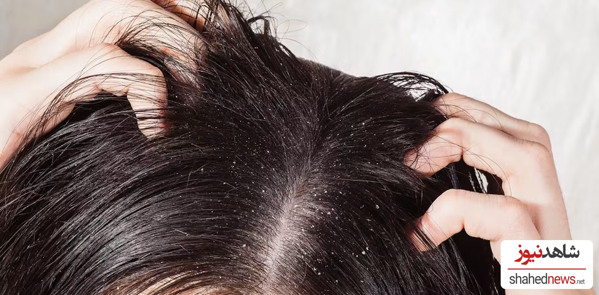 Dandruff shampoo